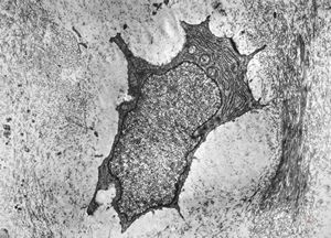 M,19y. | chondrocyte - chondrosarcoma - jaw